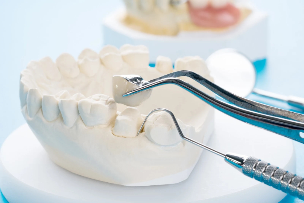crown and bridges in Kathmandu dental restoration