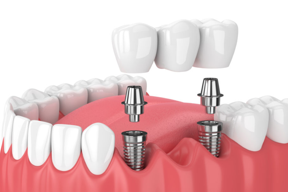 dental implants in Kathmandu Nepal at Chirayu Dentcare