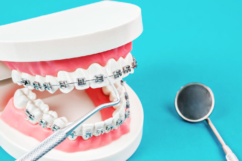 orthodontic braces in Kathmandu Nepal at Chirayu Dentcare