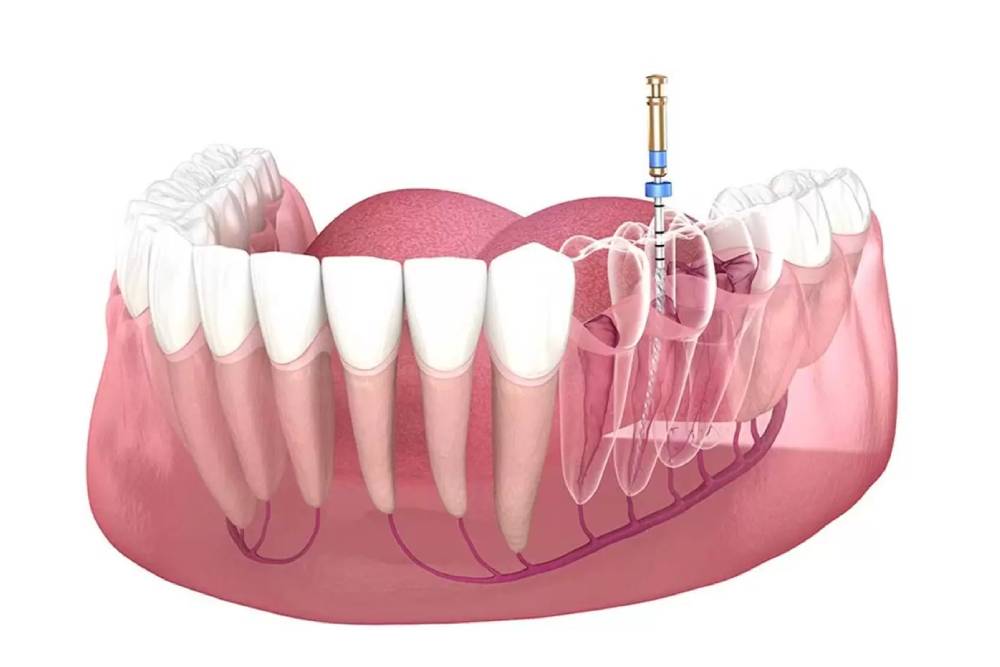 root canal treatment in Kathmandu Nepal dental procedure