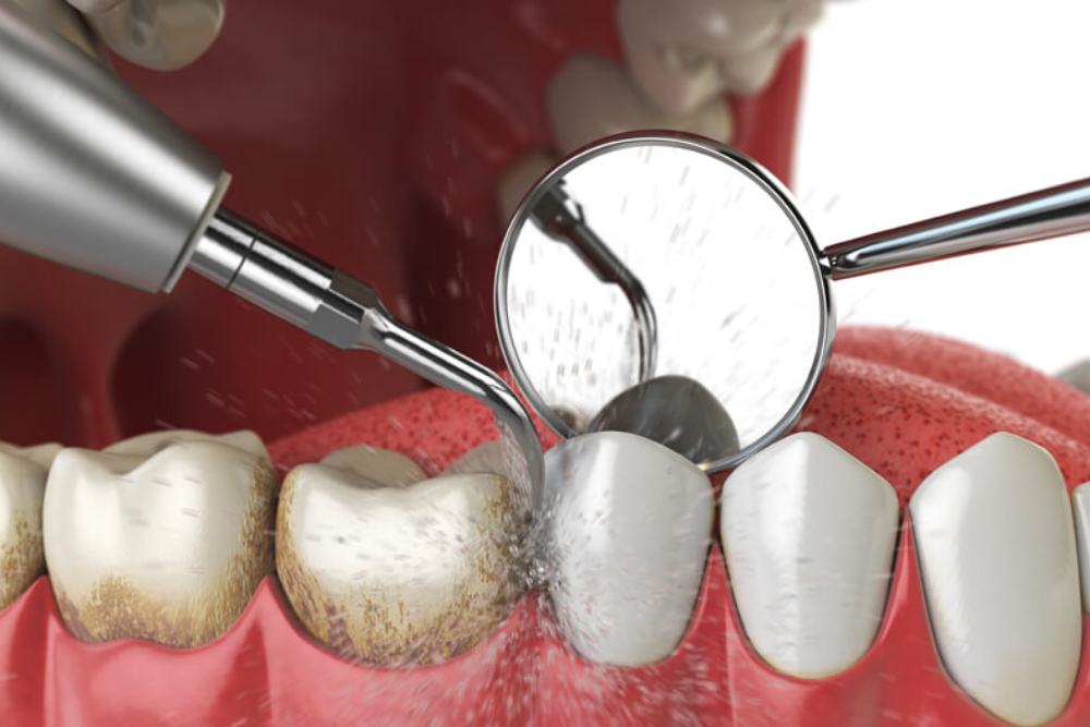 scaling and cleaning in Kathmandu Nepal Chirayu Dentcare