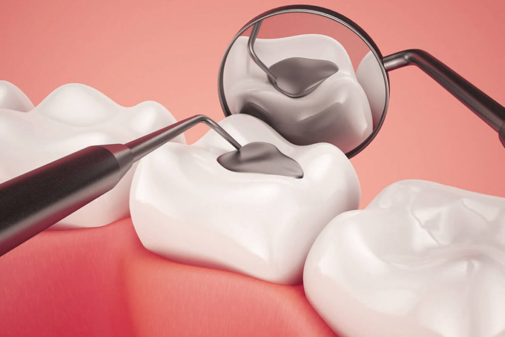 tooth filling in Kathmandu dentist procedure