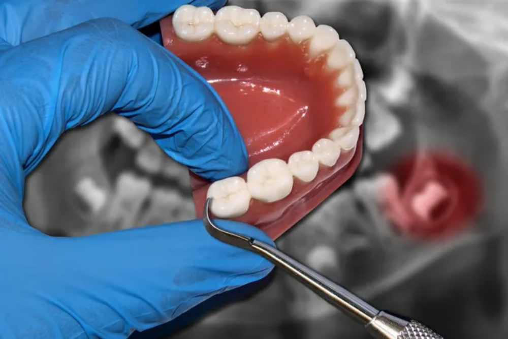 wisdom tooth removal in Kathmandu Nepal at Chirayu Dentcare