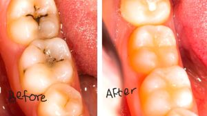 Teeth filling procedure at Chirayu Dentcare in Kathmandu