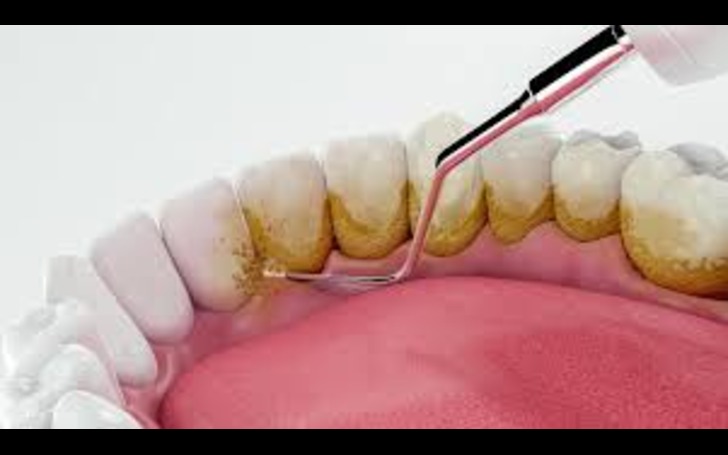 The cost of teeth scaling in Nepal generally ranges from NPR 1,500 to NPR 15,000