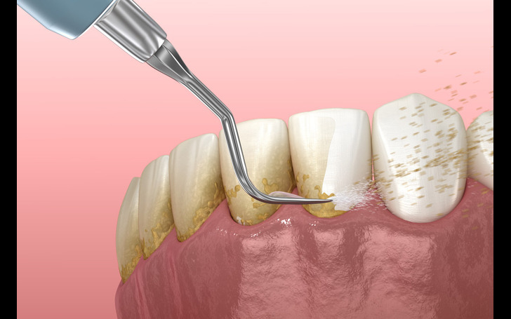 Teeth scaling should be done at least once or twice a year