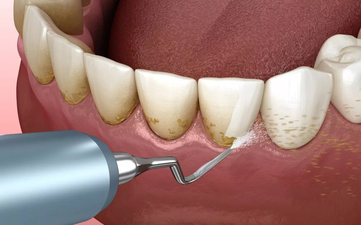 after teeth scaling, avoid consuming hot, cold, or sour foods for at least one hour post-scaling