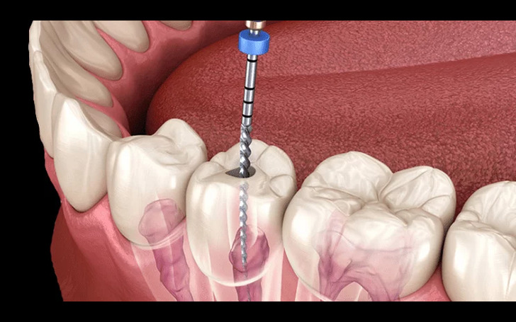 Root Canal Treatment is a painless procedure at Chirayu Dentcare Kathmandu