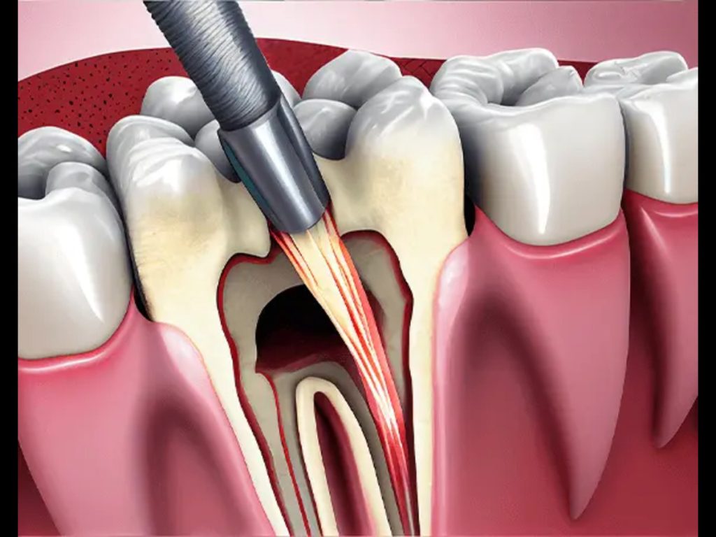 At Chirayu Dentcare, the cost of Root Canal Treatment (RCT) ranges from NPR 2000 to 8000 per tooth.