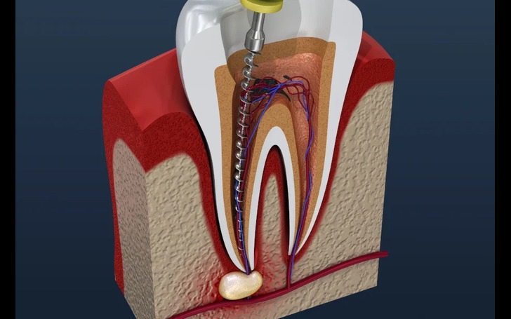Root Canal Treatment price at Chirayu Dentcare Kathmandu from NPR 2000 to 8000 depending on tooth position and infection severity