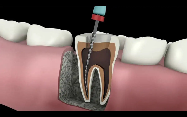Benefits of Root Canal Treatment include pain relief and tooth preservation