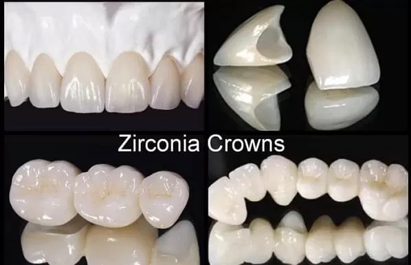 At Chirayu Dentcare, Zirconia Crown treatments start at NPR 12000