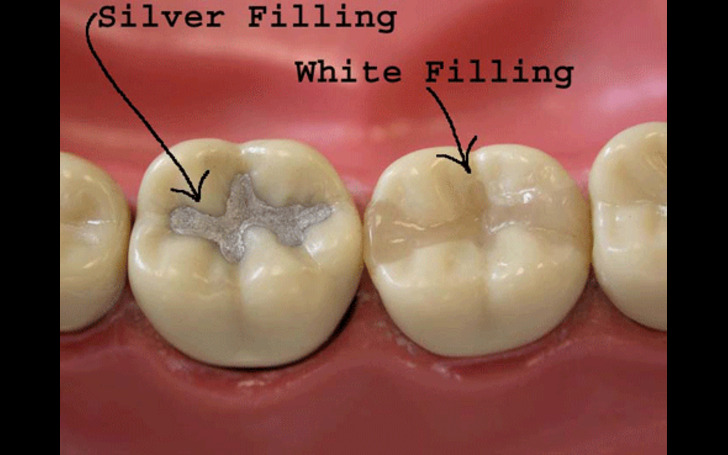 Dental filling costs at Chirayu Dentcare Kathmandu range from NPR 500 to NPR 2500