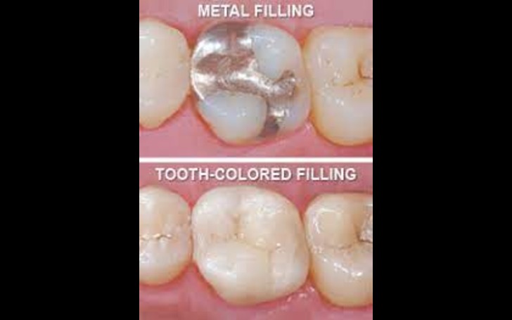Factors affecting dental filling cost such as cavity size and number of surfaces