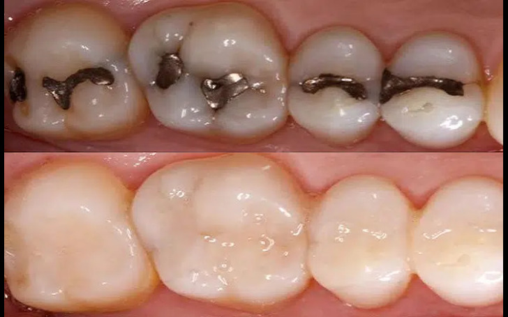 After tooth filling, mild sensitivity and soreness may occur