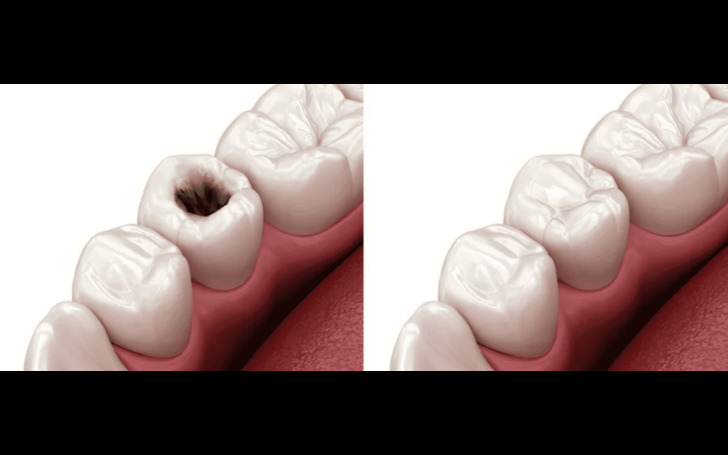 Dental fillings are painless due to local anesthesia