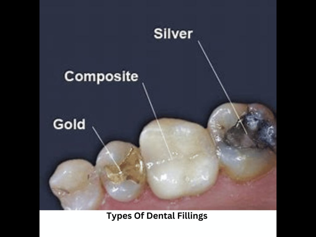Teeth Fillings Cost In Nepal at Chirayu Dentcare
