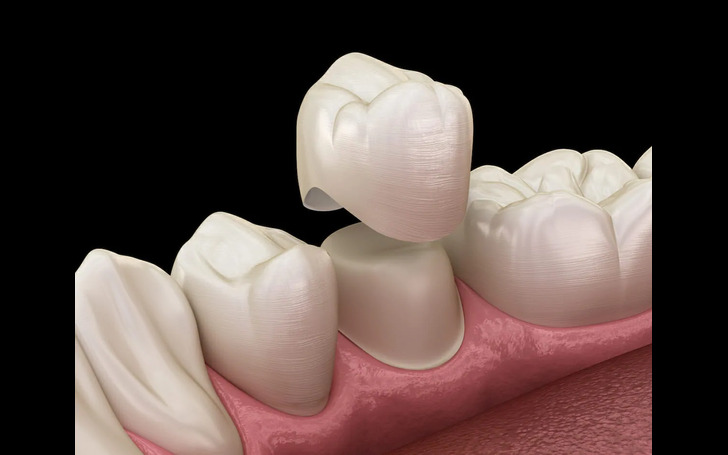 Dental Crown Price in Kathmandu Nepal including metal, ceramic, and zirconia crowns