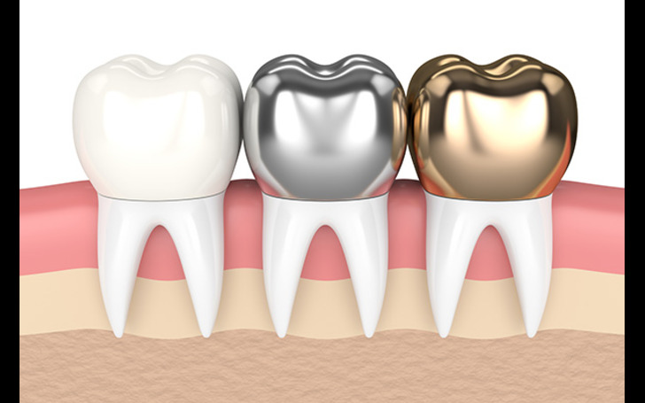 Dental Crown Price in Kathmandu Nepal at Chirayu Dentcare for metal, ceramic, and zirconia crowns