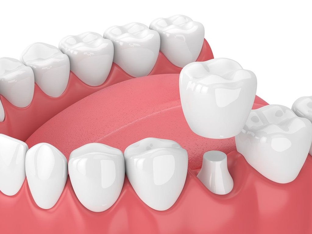 Dental Crown price in kathmandu