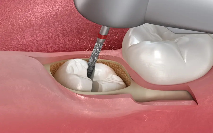 Local anesthesia is sufficient for simple extractions