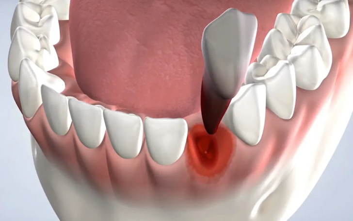 Local anesthesia is administered to numb the tooth and surrounding gum tissue during tooth extraction.