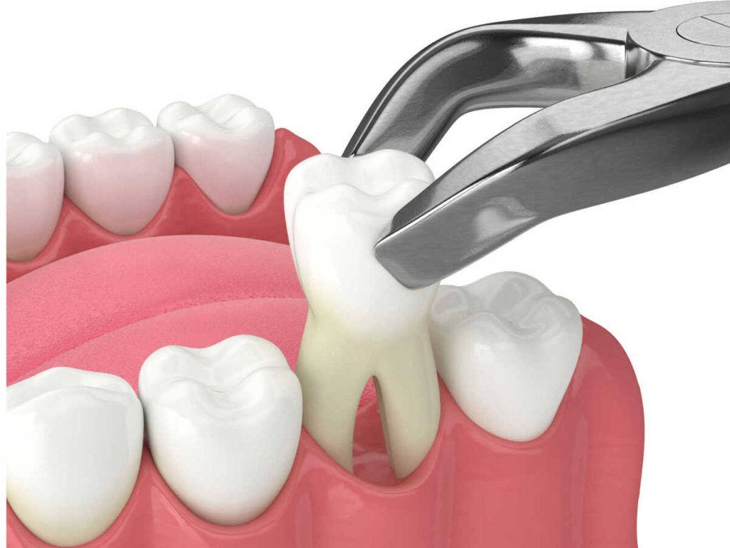 tooth extraction cost in nepal, types, benefits