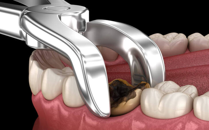 In Nepal, tooth extraction costs range between NPR 1,500 to NPR 18,000