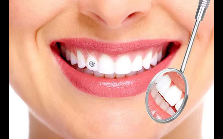 Dental jewelry price Kathmandu at Chirayu Dentcare