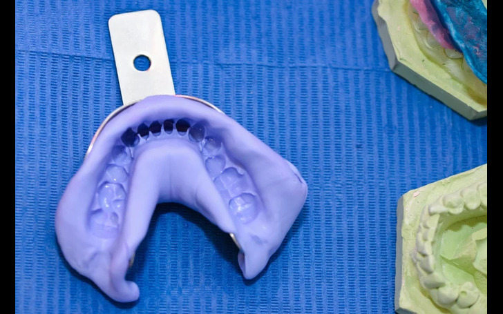 A dental impression tray filled with putty, used to create a custom retainer mold.