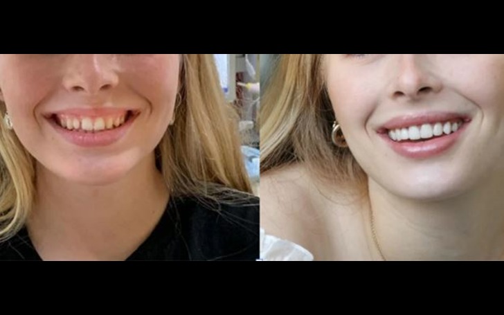 Veneers cost Kathmandu Nepal at Chirayu Dentcare