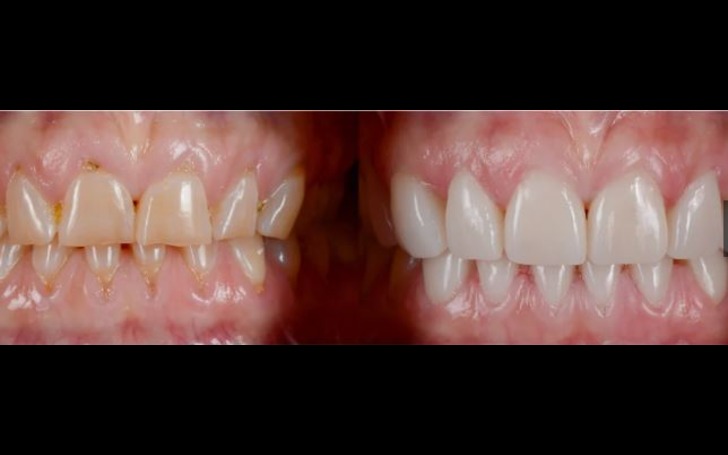 Dental veneers cosmetic dentistry Kathmandu Nepal