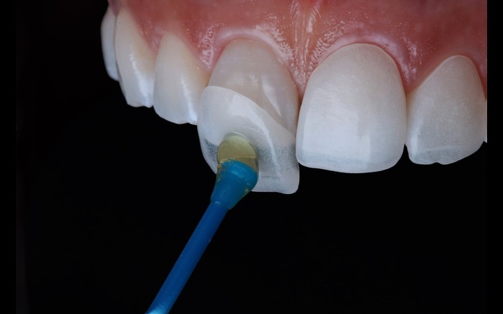 Dental veneer placement procedure Kathmandu