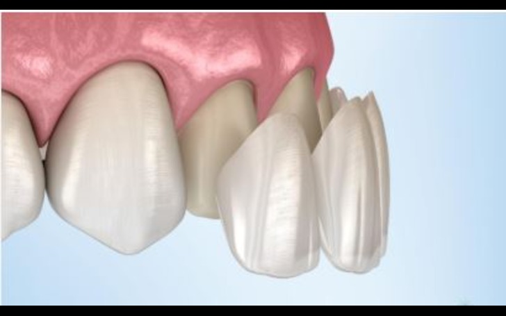 Cost of Dental Veneers in Nepal