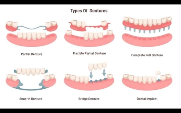 Different types of dentures including partial, complete, and implant-supported