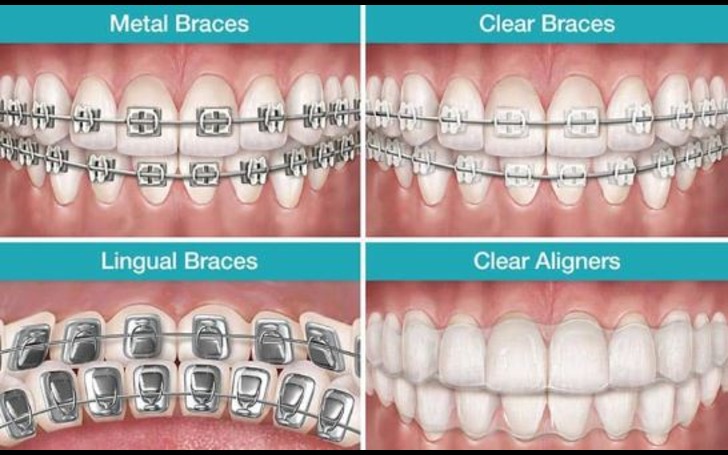 Cost of Braces Nepal - Metal, Ceramic, Lingual, and Clear Aligners