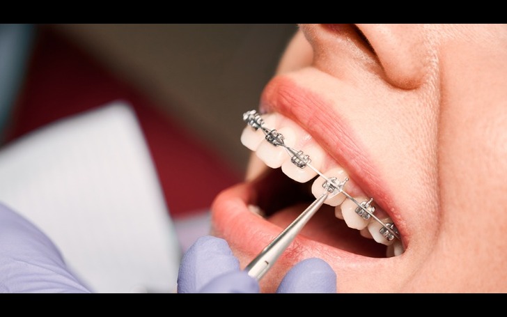 Orthodontist adjusting braces - Cost of Braces Nepal