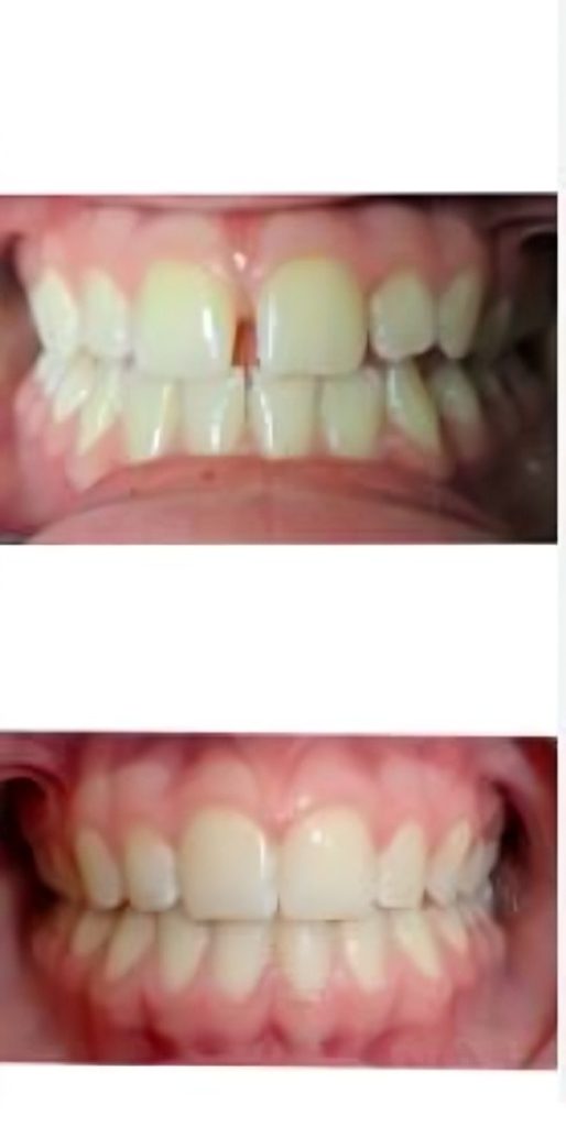 Before and after braces showing improved teeth alignment - Cost of Braces Nepal