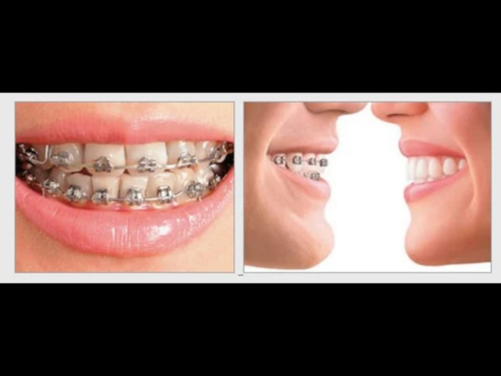 Cost of Braces Nepal - Metal, Ceramic, Lingual, and Clear Aligners