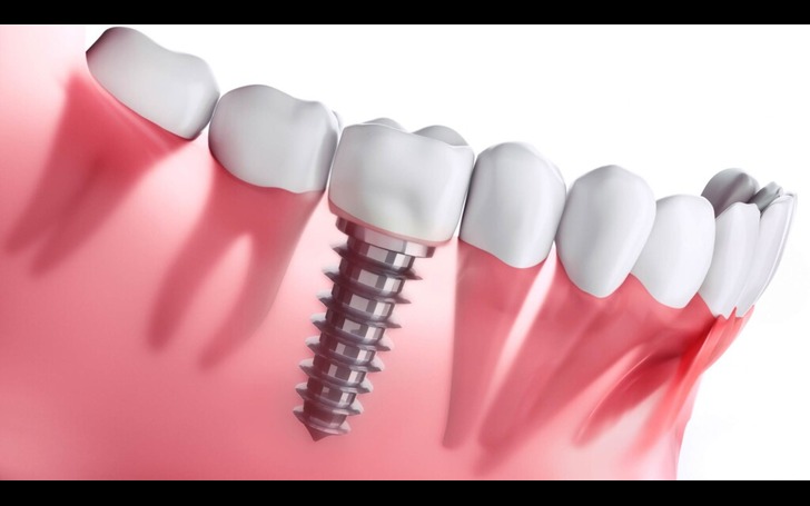 Dental implant procedure steps at Chirayu Dentcare including consultation, bone graft, implant placement, and crown attachment