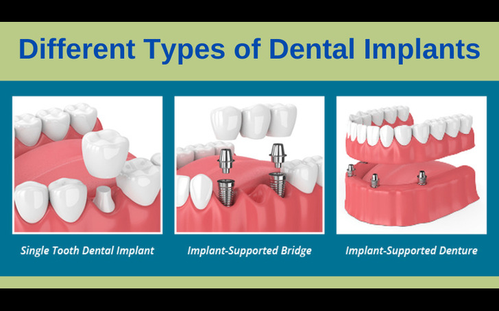 Post-surgery dental implant care at Chirayu Dentcare including soft food diet and follow-ups