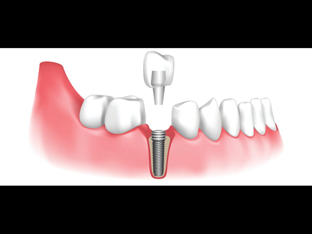 Dental Implants costs in Nepal